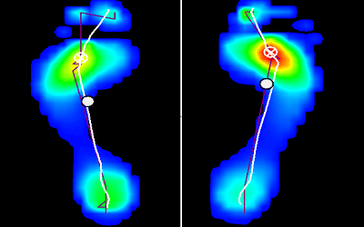 Estudio biomecánico de la pisada para todo los perfiles, sedentarios y deportistas 